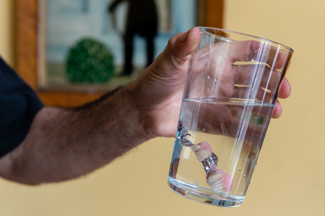 David Tuller holds up his removable partial denture. Despite regular dental check-ups, Tuller developed an advanced case of periodontitis, a chronic inflammatory condition in which pockets of bacteria infect and gradually destroy gum and bone tissue. (Heidi de Marco/KHN)